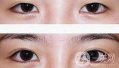 割雙眼皮多少錢？雙眼皮手術(shù)費用詳細(xì)解答