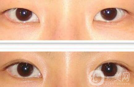 割雙眼皮多少錢？雙眼皮手術(shù)費用詳細(xì)解答