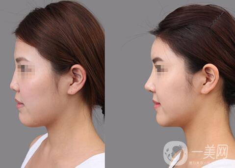 膨體隆鼻能維持多久？膨體隆鼻能保持終生嗎？