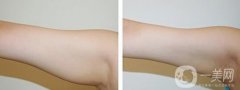手臂吸脂術后怎么護理？術后注意事項有哪些？