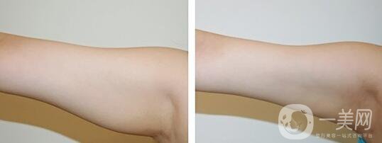 手臂吸脂術(shù)后怎么護理？術(shù)后注意事項有哪些？