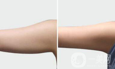 手臂吸脂術(shù)后怎么護理？術(shù)后注意事項有哪些？