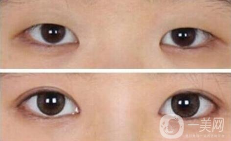 開眼角需要多少錢？開眼角和不開的區(qū)別圖
