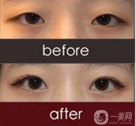 改臉型手術(shù)多少錢(qián)？改臉型手術(shù)有危險(xiǎn)嗎？