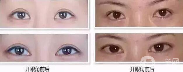雙眼皮開眼角價(jià)格是多少？割雙眼皮開眼角多少錢？