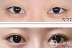 雙眼皮開眼角價格是多少？割雙眼皮開眼角多少錢？