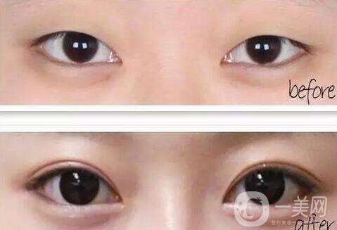 雙眼皮開眼角價(jià)格是多少？割雙眼皮開眼角多少錢？