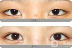 開眼角割雙眼皮價格、開眼角割雙眼皮多少錢？