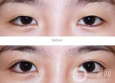 成都割雙眼皮哪里專業(yè)？割雙眼皮介紹？