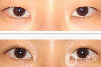 成都割雙眼皮哪里專業(yè)？割雙眼皮介紹？