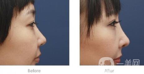 深圳做硅膠隆鼻多少錢？硅膠隆鼻費(fèi)用詳細(xì)解析