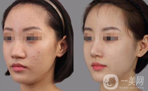 深圳做硅膠隆鼻多少錢？硅膠隆鼻費(fèi)用詳細(xì)解析