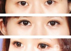 割雙眼皮要花多少錢？割雙眼皮手術(shù)價格詳細(xì)解析