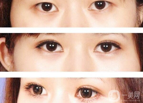 割雙眼皮要花多少錢？割雙眼皮手術價格詳細解析