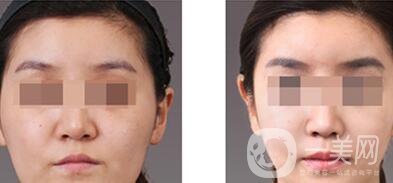 上海自體脂肪豐眉弓價(jià)格、自體脂肪豐眉弓多少錢