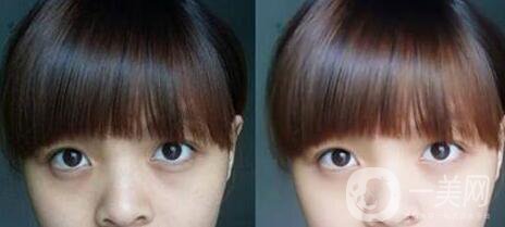 黑眼圈可以打玻尿酸嗎？玻尿酸去黑眼圈*果如何？