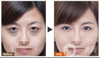 黑眼圈可以打玻尿酸嗎？玻尿酸去黑眼圈*果如何？