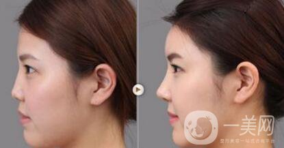 上海假體隆鼻多少費用？假體隆鼻價格詳細分析