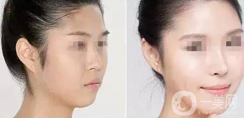 上海假體隆鼻多少費用？假體隆鼻價格詳細分析