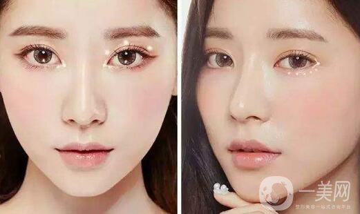  切割雙眼皮恢復(fù)多久好