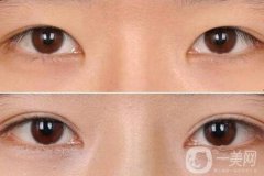 割雙眼皮后注意什么？術(shù)后注意事項(xiàng)盤(pán)點(diǎn)~