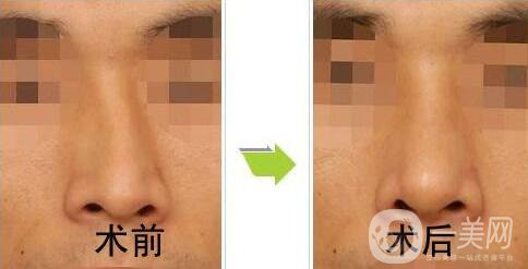 歪鼻矯正一般多少錢(qián)？歪鼻矯正手術(shù)價(jià)格詳細(xì)解析