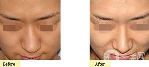 歪鼻矯正一般多少錢(qián)？歪鼻矯正手術(shù)價(jià)格詳細(xì)解析