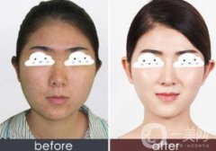 光子嫩膚果怎么樣？光子嫩膚多長時間做一次？