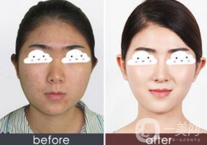 光子嫩膚*果怎么樣？光子嫩膚多長時間做一次？