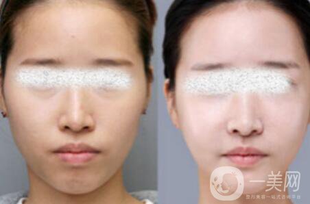 光子嫩膚*果怎么樣？光子嫩膚多長時間做一次？