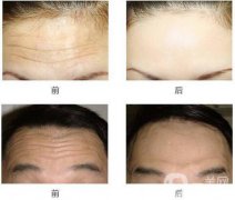 去抬頭紋好的方法？去抬頭紋那種方法好？