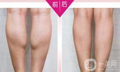 **果好嗎？*多少錢一針？