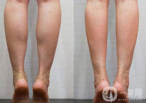 **果好嗎？*多少錢一針？