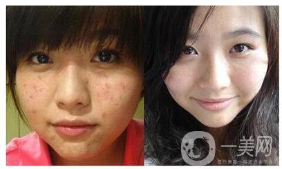 廣州e光祛痘價格貴不貴？多少錢？