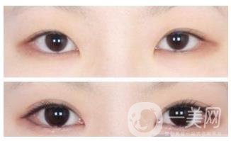 北京開眼角費用需要多少錢