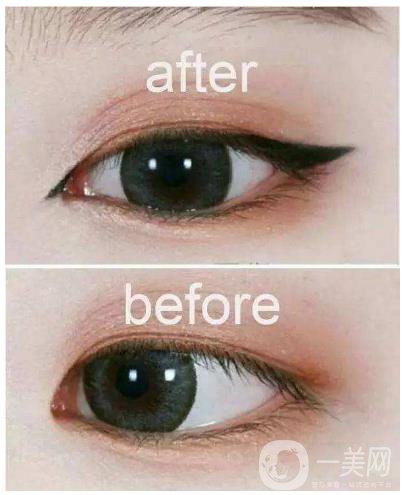 開眼角手術過程 開眼角前后照片圖