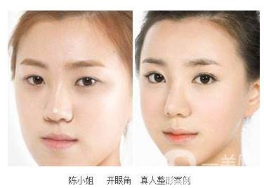 開眼角手術過程 開眼角前后照片圖