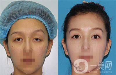 上瞼下垂矯治術(shù)多少錢？詳細(xì)價(jià)格盤點(diǎn)~