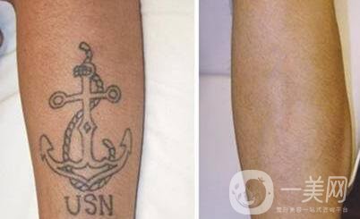 醫(yī)院洗紋身價格 收費明細詳解