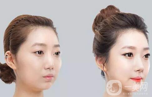 咬肌切除手術(shù)多少錢(qián)？切除咬肌價(jià)格收費(fèi)明細(xì)~