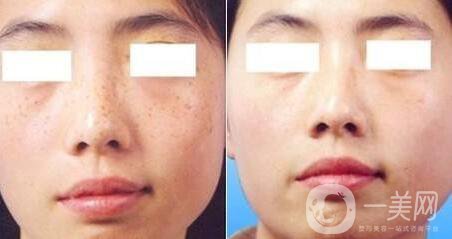去雀斑價格 去雀斑價收費明細說明