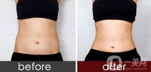 吸脂手術(shù)*嗎？如何降低風(fēng)險(xiǎn)？