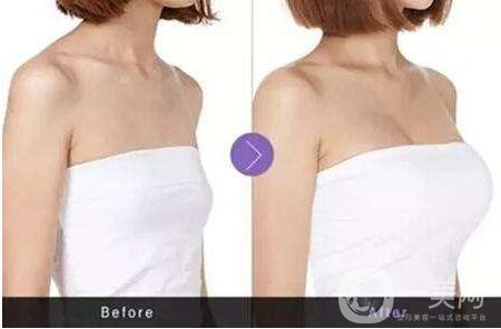 妙桃假體隆胸多少錢 收費明細詳解