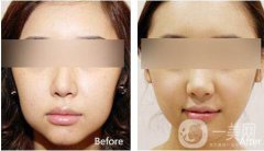 改臉型要多少錢？改臉型價(jià)格是多少？