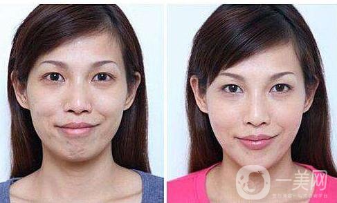 熱瑪吉,除皺,*果