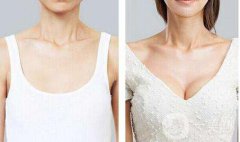 妙桃假體隆胸多少錢？妙桃假體隆胸價(jià)格？