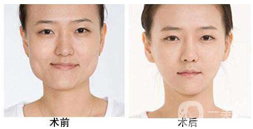 削骨手術(shù)危險嗎 怎樣降低手術(shù)危險