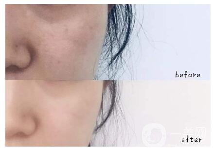 怎樣快速去痘印 什么方法可以去痘坑