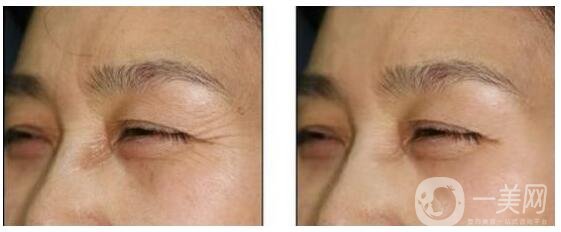 眼角皺紋怎么樣祛除 祛除眼角魚尾紋的方法