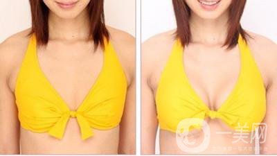 怎樣除去抬頭紋?快速去抬頭紋方法推薦